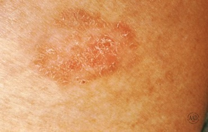 Как защитить себя от рака кожи, - советы от медиков