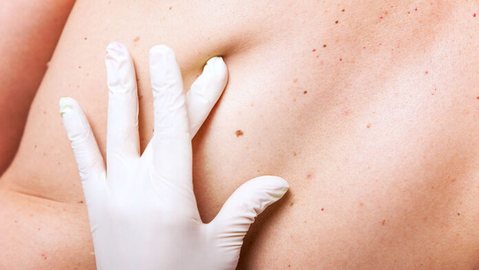 Как защитить себя от рака кожи, - советы от медиков