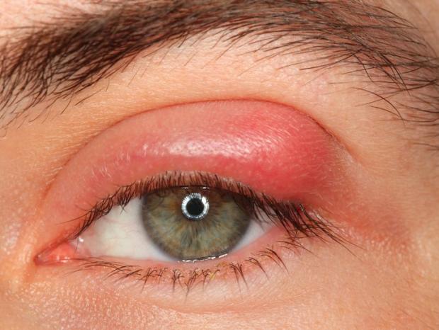 Ячмень на глазу: симптомы и лечение