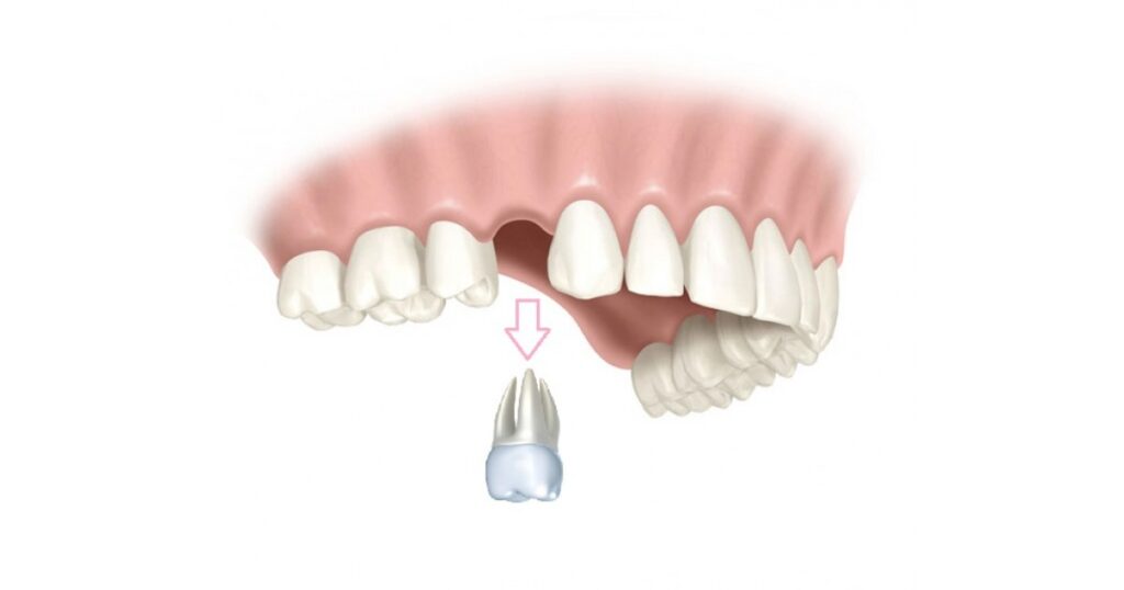 Стоматологи назвали главные причины выпадения зубов
