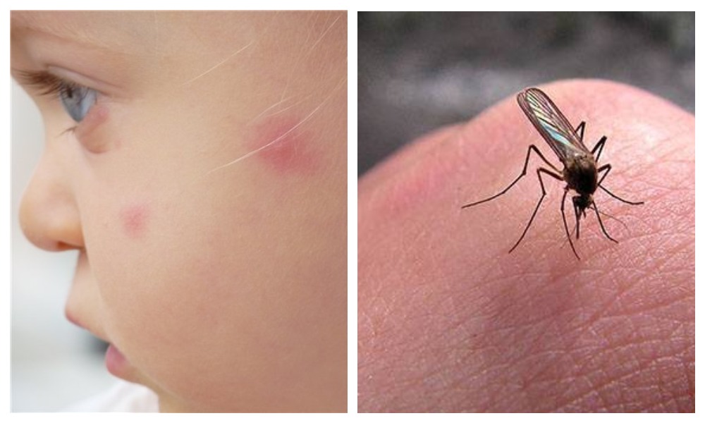 Как спастить от укусов комаров - совет Комаровского