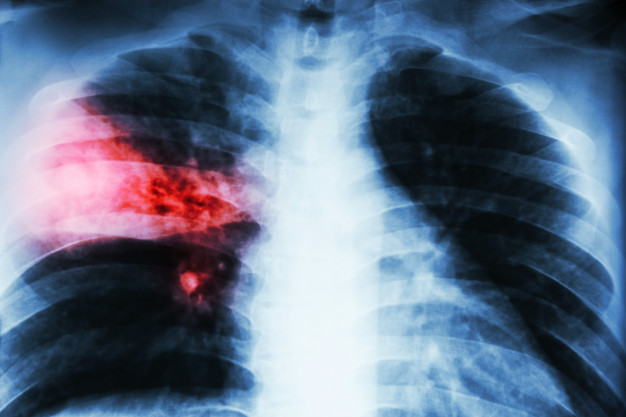 Какие ранние симптомы туберкулеза важно не пропустить