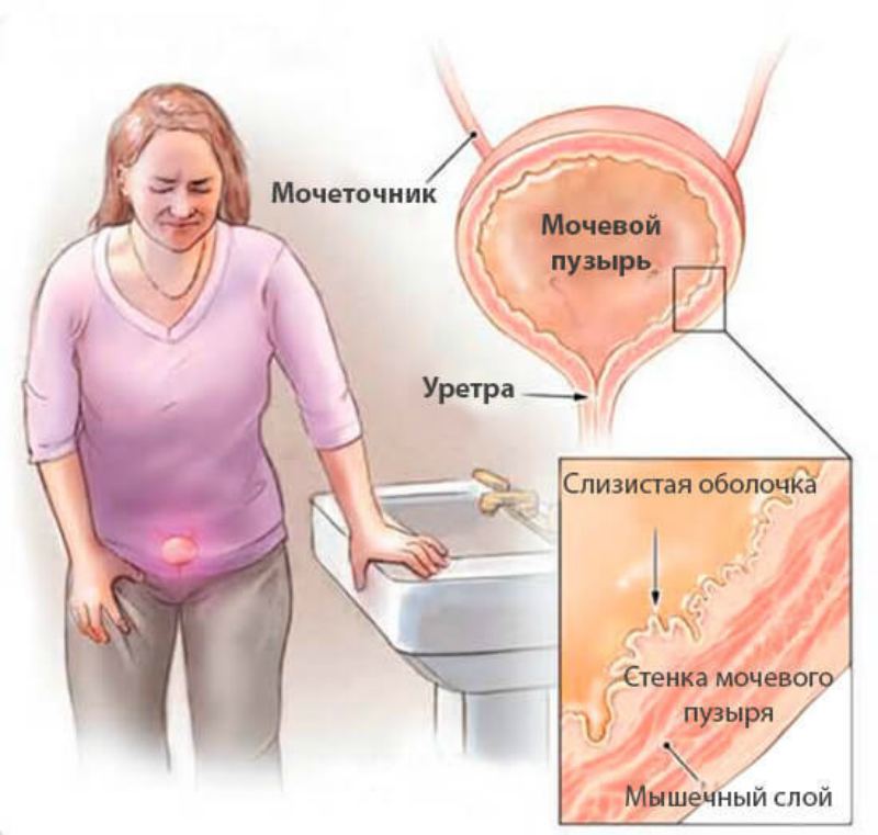 Какие симптомы инфекции мочевого пузыря