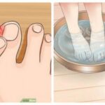 Как избавиться от вросшего ногтя: пошаговая инструкция