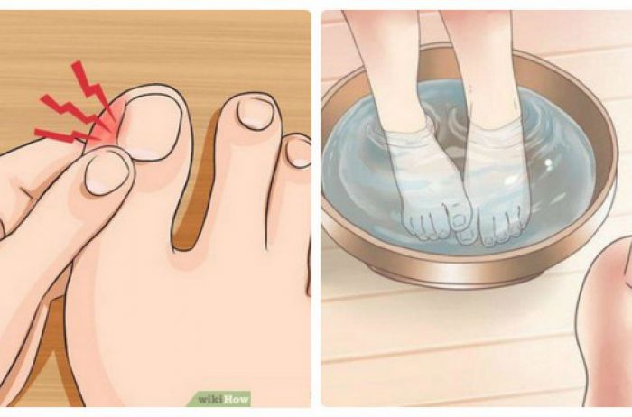 Как избавиться от вросшего ногтя: пошаговая инструкция
