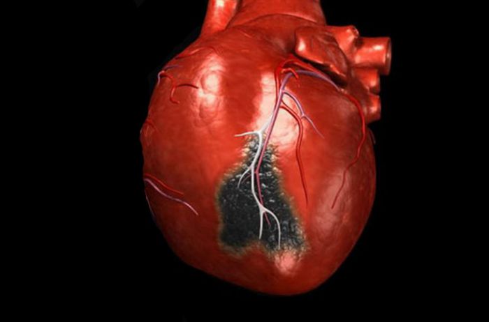 Признаки инфаркта, при которых нужно звонить в скорую
