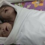 В Мьянме родился ребенок с двумя головами: малыша не признали сиамским близнецом ФОТО