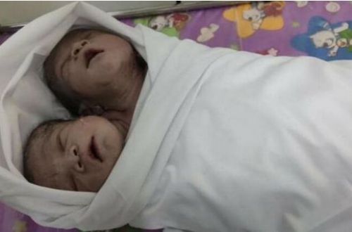 В Мьянме родился ребенок с двумя головами: малыша не признали сиамским близнецом ФОТО