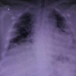 Пневмония при COVID-19: пульмонолог перечислил особенности