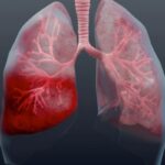 Как выявить пневмонию на ранней стадии и быстро её вылечить