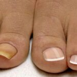 Почему ногти желтеют, чернеют, слоятся? Способы лечения и профилактические меры