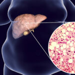 Жировой гепатоз печени: симптомы и методы лечения