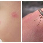 Как спастить от укусов комаров – совет Комаровского