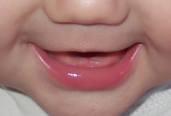 Прорезывании зубов у детей: симптомы, как не перепутать с вируской и как помочь малышу