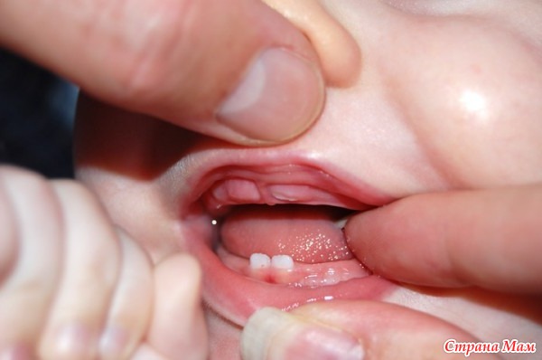 Прорезывание Зубов у Детей
