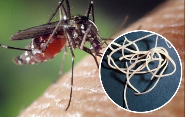 В Кривому Розі у жінки після укусу комара виріс під шкірою 11-сантиметровий гельмінт